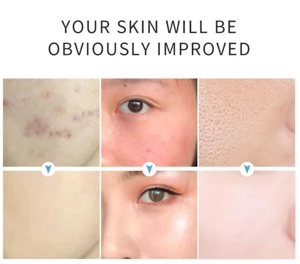 AICHUN BEAUTY Face Serum Salicylic Acid Purifying Shrink Pores Exfoliation Anti-Acne Skin Care Ac3074 30ml AC3074